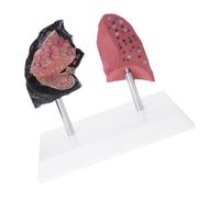 Polmone che gonfia rispetto modello comparativo sano per la formazione clinica Strumento didattico per struttura permanente in PVC Modello struttura patologica