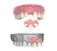 Protesi Protesi Parziali Personalizzate Protesi Rimovibili, Protesi Dentali Portatile per Denti (1 Dente)