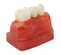Qukaim Modello di impianto dentale 4 volte, modello di impianto dentale 4 volte, modello di dimostrazione dei denti a ponte della corona per medici, educazione del paziente, analisi dettagliata dei
