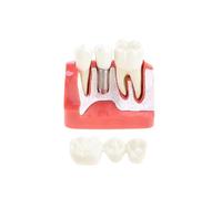 (Red) Implant Model Crown Bridge Demonstration Class Education Studying Teeth Model