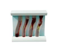 Ronyme Modello di Patologia Vascolare in PVC | Didattico, Resistente, Modello, per Aula Scolastica, Insegnanti, Modello Dinamico