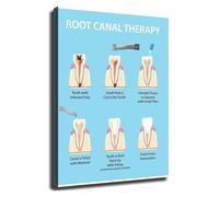 Root Canal Information Poster Wall-Art for Decor(Framed,16x24inch(40x60cm))