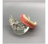 RUXMY Modello didattico Impianti dentali - Modello di insegnamento dei Denti - Impianti per overdenture mandibolare Modello dimostrativo inferiore2