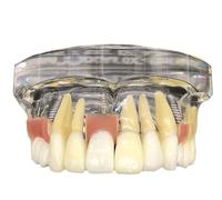 Ryanong Modello di dente Typodont per il restauro dell'impianto, modello di dente per l'analisi dell'impianto mascellare dimostrativo con denti rimovibili e gomma morbida per l'insegnamento dello
