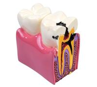 Sarini Modello Dentale, Modello di Studio comparativo della Carie, Modello didattico di Anatomia Dentale per Dentisti, Adatto a Dentisti, pazienti, Insegnanti e Studenti