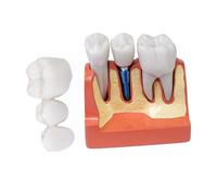 Sarini Modello di Dente Orale, Modello di impianto Dentale con Corona e Ponte Rimovibili, Adatto per dimostrazioni in Aula e Formazione per Studenti di odontoiatria