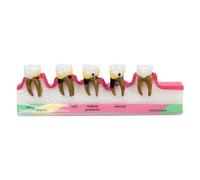 Sarini Modello parodontale Dentale da 1 Pezzo, Modello di Sviluppo della Carie, Modello di parodontite per Modello Dentale, classificazione parodontale, dimostrazione didattica