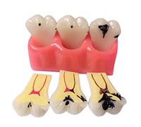 SdaryWare Modello di Denti con Carie Dentale - Modello di smontaggio dei Denti con Carie 4 Volte - Modello di smontaggio dei Denti con Carie per Dentisti, pazienti, Insegnanti e Student,Red