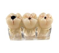SdaryWare Modello di Denti con Carie Dentale - Modello di smontaggio dei Denti con Carie 4 Volte - Modello di smontaggio dei Denti con Carie per Dentisti, pazienti, Insegnanti e Student,White