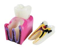 SdaryWare Modello di Denti con Carie Dentale - Modello di Studio comparativo di Denti cariati 6 Volte - per Strumenti didattici per la patologia di confronto bilaterale della Carie, MOD,Flesh-12cm
