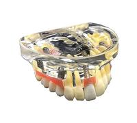 SdaryWare Modello di Denti implantari - Modello di Formazione per impianti dentali - con Gengive morbide, per l'insegnamento delle scienze, Strumento di Comunicazione Medico-paziente,A