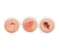 Set di modelli anatomici di lesioni cutanee di grado 1-3