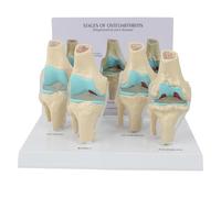 Set di modelli di malattie dell'articolazione del ginocchio, mostra lesioni degenerative del ginocchio in 4 stadi, osteoartrite normale e morbosa