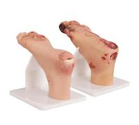 Set di Modelli di Ulcere del Piede Diabetico, Modello di Alterazioni Patologiche delle Ulcere del Piede, Studio della Patologia in Fase Lieve E Grave, Strumento di Formazione Medica
