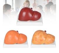 Set Modelli Anatomici del Fegato, 3 Modelli Patologici Scala 1:1,3PCS | Confronta Fegato Normale, Fegato Grasso Non Alcolico e Alcolico per l’Insegnamento dell’Anatomia,3PCS