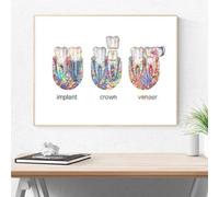 SHINERING Poster Su Tela Con Impianto Dentale, Corona Dentale, Anatomia Dei Denti, Immagini Artistiche Da Parete Mediche Per La Decorazione Della Clinica Dentale 40X50Cm Senza Telaio