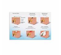 Skincare Decor Acne Face Map Chart Canvas Wall-Art for Room or Self Care Space at Home(Unframed,16x24inch(40x60cm))