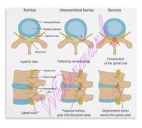 Spinal Canal Stenosis Types Poster Central vs Foraminal Stenosis Comparison Health Infographic Wall Print(Unframed,08x12inch(20x30cm))
