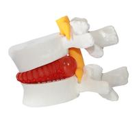 Sussidi didattici per alleviare l'ernia del disco, modello del corpo umano in PVC di ernia del disco della vertebra lombare, modello di colonna lombare a grandezza naturale 1, 5 volte per insegnare
