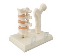 Sxhlseller Modello Spinale per L'osteoporosi, Visualizzazione Interattiva dei Cambiamenti Patologici, Strumento di Apprendimento Versatile, Pratica Medica, Ergonomia, Materiale ABS