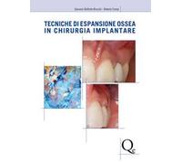 Tecniche di espansione ossea in chirurgia implantare