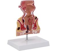 TGPSMDXKV Modello di retto Umano 1,5X con patologie Comuni, Replica per l'insegnamento dell'anatomia e della fisiologia, Modello anatomico per l'insegnamento delle lesioni rettali umane