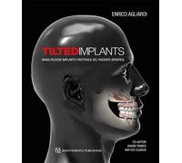 Tilted implants. Riabilitazione implanto-protesica del paziente a