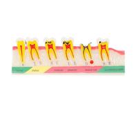 TOBBOMEY Modello di Dente Educativo Resistente e Portatile Modello Didattico di Denti Patologici Carie per Dimostrazione Odontoiatrica e Studio Clinico