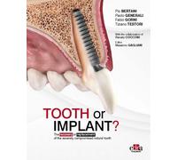 Tooth or Implant? The recovery or replacement of the severely compormised ...