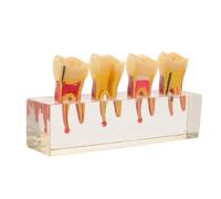 Totority Modello Didattico di Elementi Dentali Primari in Resina Anatomia Orale per Dimostrazione Clinica e Pratica Manuale della Progressione della Carie per Studenti e Pazienti Giovani