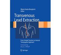 Transvenous Lead Extraction: From Simple Traction to Internal Transjugular Approach