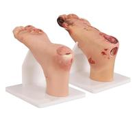 UIGJIOG Set Modello di Piede Diabetico con Ulcera Plantare Pathology Accuratezza Anatomica Studio Patologia Stadio da Lieve a Grave Strumento di Formazione Medica per Professionisti Sanitari