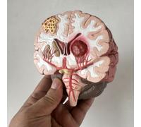 Umana Cerebrale Malattia Modello Cerebrale Pathology Brainstem Hemorrhage Medico