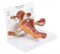 UNbit Modello di Utero patologico Umano, Modello di Struttura Anatomica dell'organo riproduttivo Interno Femminile, Modello di Struttura Anatomica dell'organo riproduttivo Interno Femminile