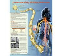 Understanding Multiple Sclerosis Anatomical Chart (Poster)