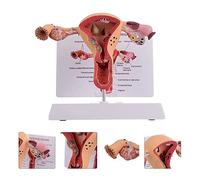 Utero Femminile patologico Umano Modello Sistema riproduttivo Interno Organo Modello anatomico Modello di Anatomia Umana