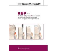 VEP. Vertical edgeless preparation: la dominanza parodontale nella preparazione protesica