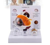WADPP Modello Anatomico di Occhio con Cataratta - Modello di Bulbo Oculare Umano con 5 Lenti Interscambiabili per Insegnamento Medico, Oftalmologia e Educazione del Paziente in PVC