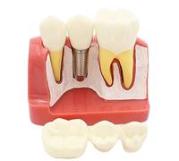 Wudaizhi Modello di impianto Dentale 4 Volte, Modello Rimovibile di analisi, Corona per dimostrazione del Ponte dei Denti