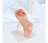 XCSCUK Modello del piede diabetico, lesioni purulente delle ferite lievi/gravi, strumenti di presentazione per anatomia, fisiologia, cura delle ferite (lieve)