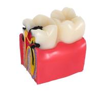 Yardenfun Modello Didattico Carie Ingrandito Strumento Educativo Comparativo per Dentisti e Studenti Simulazione Precisa per Studio e Uso Professionale e Domestico