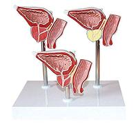 YHNNH, Modello anatomico del sistema urinario umano, modello di malattia della ghiandola della fessura anteriore in tre parti for lo strumento di presentazione scolastica