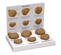 YHNNH, Modello anatomico patologico patologico della prostata a contrasto maschile - Modello anatomico della prostata Studio e insegnamento di organi umani Modelli anatomici