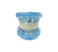YOUYA - Modello dentale trasparente per denti di malattia dentale, modello dentale dentale trasparente, modello dentista, malattia standard rimovibile, modello di insegnamento patologico, colore: blu