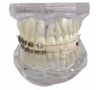 YRQMGSF Modello di confronto del Vassoio Dentale - Confronto del Modello didattico metà Metallo e metà Ceramica - per l'educazione e Le dimostrazioni odontoiatriche