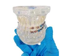 YRQMGSF Modello Ortodontico Dentale, Modelli Dentali con Apparecchi Metallici Trasparenti, per Insegnare la Comunicazione Medico-Paziente