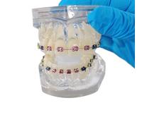 YRQMGSF Modello Ortodontico Dentale, Modelli Dentali con Apparecchi Metallici Trasparenti, per Insegnare la Comunicazione Medico-Paziente