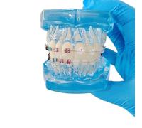 YRQMGSF Modello Ortodontico Dentale, Modelli Dentali con Apparecchi Metallici Trasparenti, per Insegnare la Comunicazione Medico-Paziente