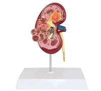 YUANZHOU Modello Anatomico di Rene Umano Modello di Malattia Renale Modello di Rene Urologia