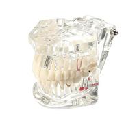 YUMILI Modello Denti Estraibili Trasparente, Modello Denti Dimostrativo, Modello Dentale Tipodontico con Impianti e Denti Rimovibili per Dimostrazioni Didattiche e Ricerca in Ambito Odontoiatrico